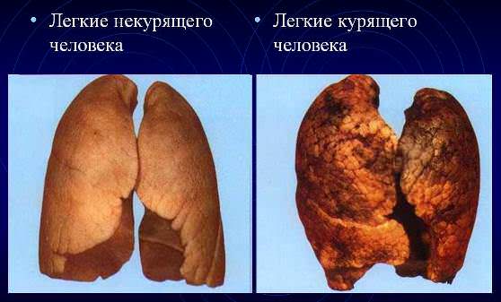 Легкие курильщика и здорового человека 
