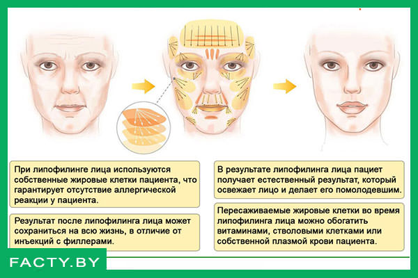 Процедура липофилинга лица